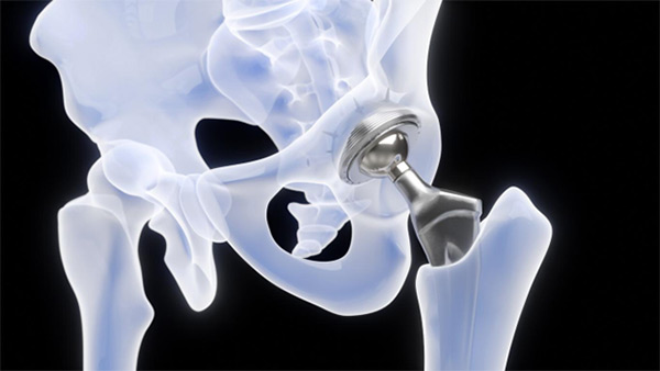 The Latest Innovations in Robotic-Assisted Hip and Knee Replacement Surgery